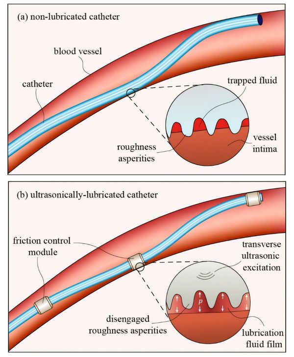 Breakthrough in Vascular Procedures: Revolutionary Catheter Technology Reduces Friction by Up to 60%